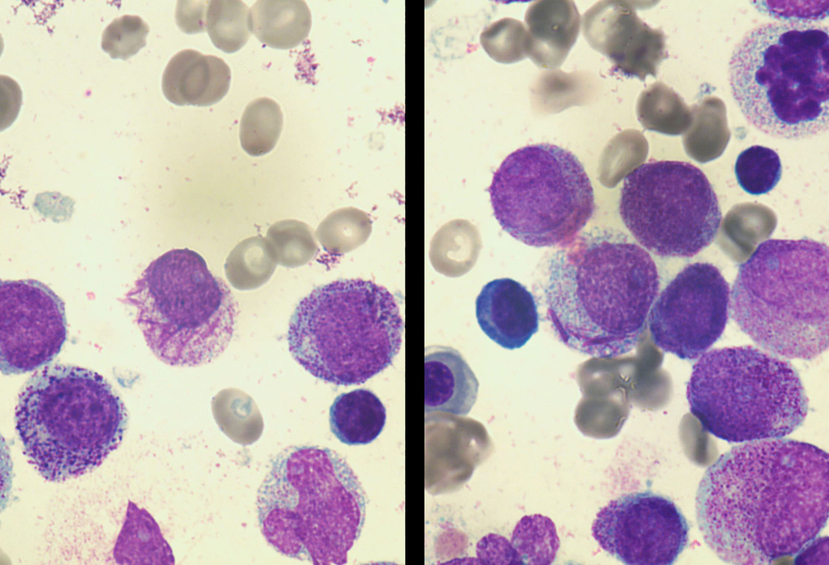Auer rods were readily identified (Aspirate smear, Wright-Giemsa, 40x).